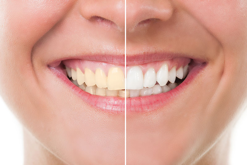 Teeth Whitening - DiTola Family Dental, Melrose Park Dentist